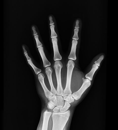 rentgen dlani