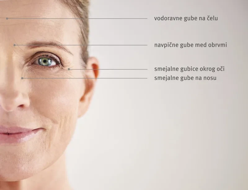 Botox Gorenjska – varen estetski poseg