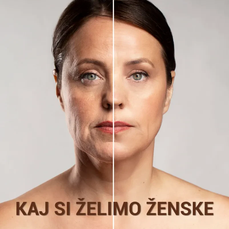Botox za svež in mladosten videz, rezervirajte termin na Gorenjskem