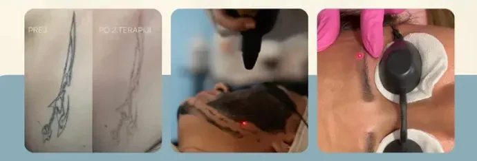 Laserski tretmaji za depilacijo in odstranjevanje tetovaž Dravograd