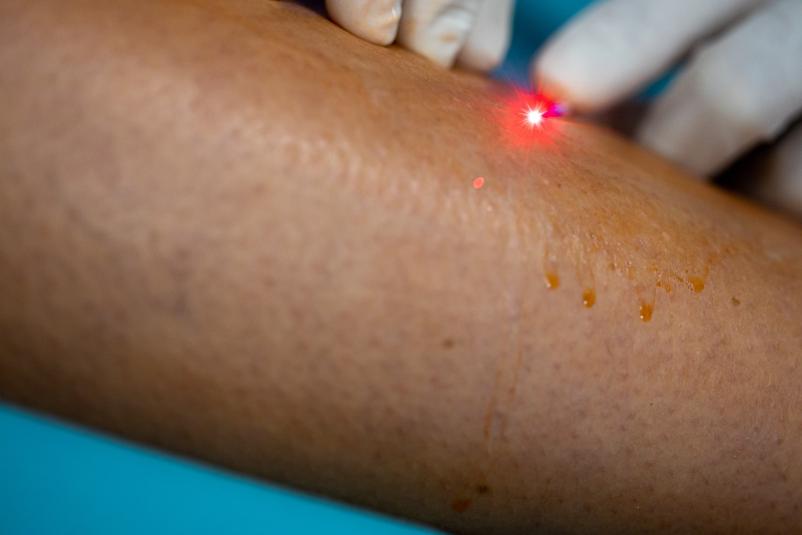 Lasersko odstranjevanje krčnih žil Dolenjska
