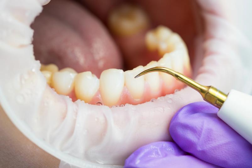 Darilni boni za samoplačniško peskanje poliranje ultrazvok zob Ljubljana