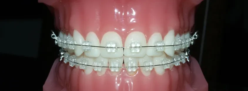 Nevidni aparat - invisalign, ortodont, Orthas d.o.o., Murska Sobota