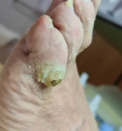 Medicinska pedikura Podravska