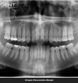 Zobni rentgen, Ortopan