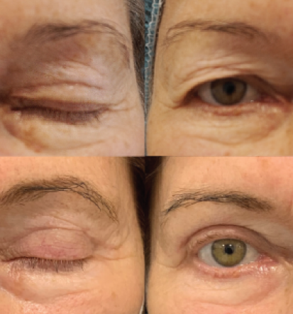 Rinoplastika Slovenija