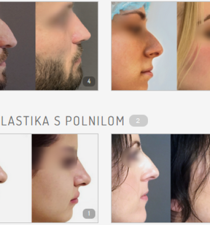 Estetski posegi, lepotna operacija Slovenija