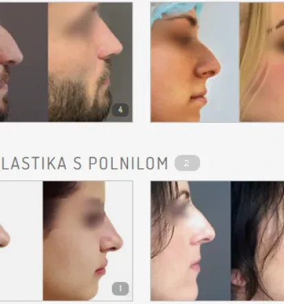 Estetski posegi, lepotna operacija Slovenija