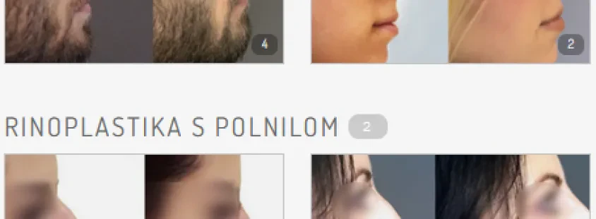 Operacija nosu Slovenija