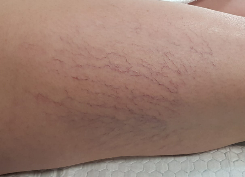Za zdravljenje krčnih žil v Sloveniji se obrnite na nas