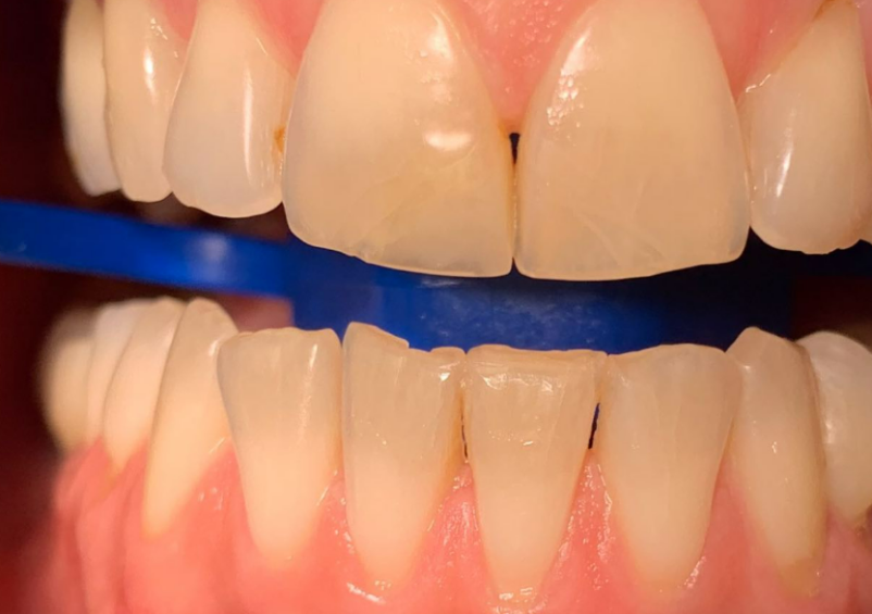 A to še ni vse! Si želite lepega in belega nasmeha?