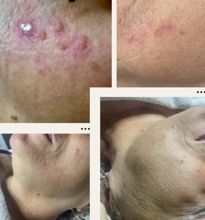 Naš poudarek je na zdravljenjem kože dermastetiko Koroška