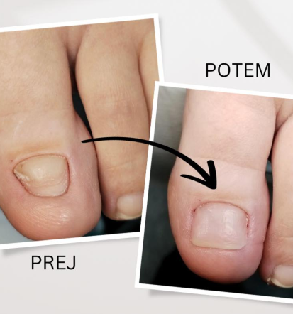 Vraščeni nohti in medicinska pedikura v dobrem kozmetičnem salonu Podravska