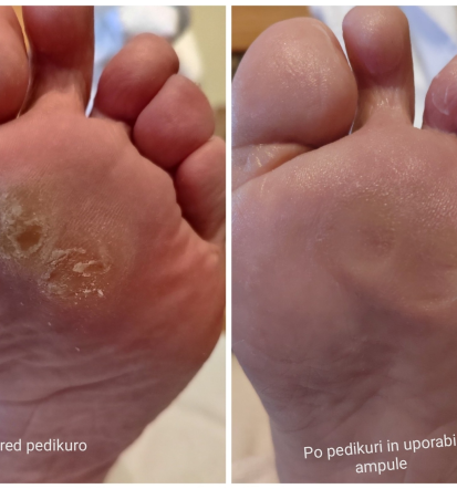 Profesionalna pedikura na domu Poljčane in okolica