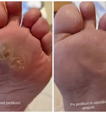 Profesionalna pedikura na domu Poljčane in okolica