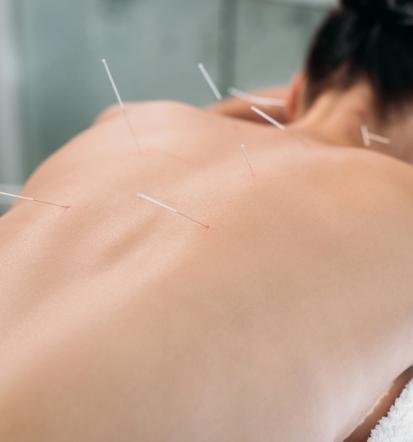 Poceni akupunktura Osrednja Slovenija