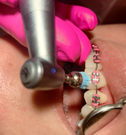 Kvalitetno zdravljenje zobne parodontoze Ivančna Gorica – preventiva in nega