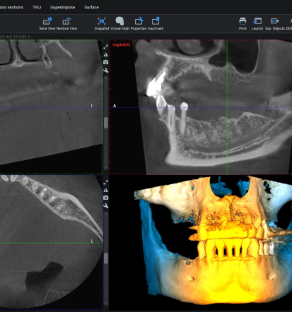 Ugoden implantat Ljubljana, za lep in zdrav nasmeh