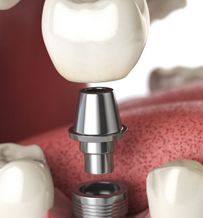 Zobni vsadek Ljubljana, Osrednja Slovenija