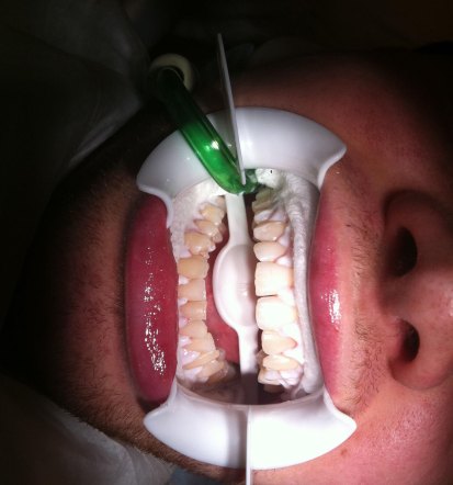 Kvalitetno zdravljenje zobne parodontoze Ivančna Gorica, strokovna nega dlesni