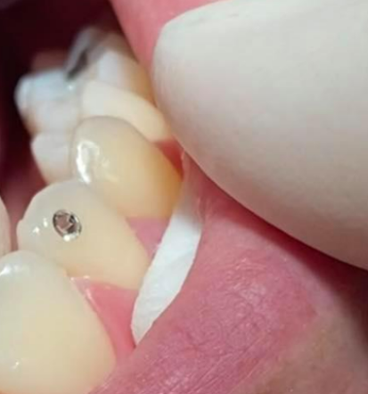 Zdravje dlesni v Ivančni Gorici, kvalitetno zdravljenje zobne parodontoze