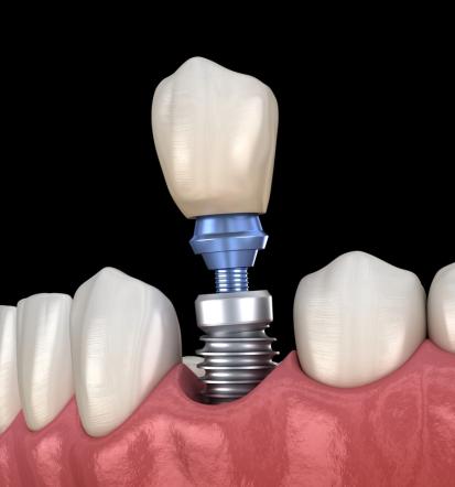 Hitra izvedba zobnih vsadkov Ljubljana