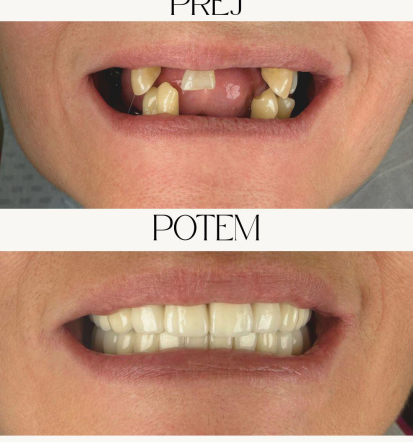 Brez bolečin do poravnanih zob