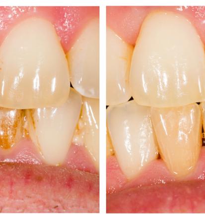 Ustna higiena in preventiva pri Čibeju Miranu