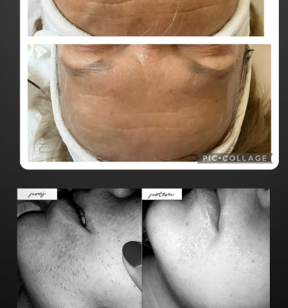 Microneedling Škofja Loka, Gorenjska po meri vaše kože