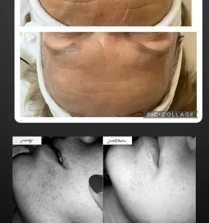 Microneedling Škofja Loka, Gorenjska po meri vaše kože