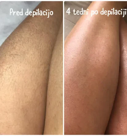 Lasersko odstranjevanje dlak na nogah Kidričevo