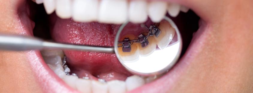 Samoplačniško peskanje poliranje ulztrazvok zob Ljubljana